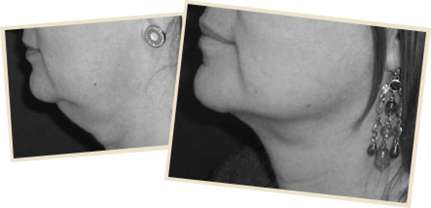 Seeing double? Say Goodbye to Your double Chin with Laser Lipo Seeing double? Say Goodbye to Your double Chin with Laser Lipo